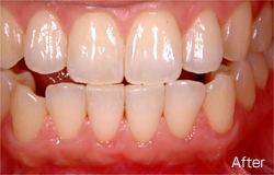 歯周治療1 After01