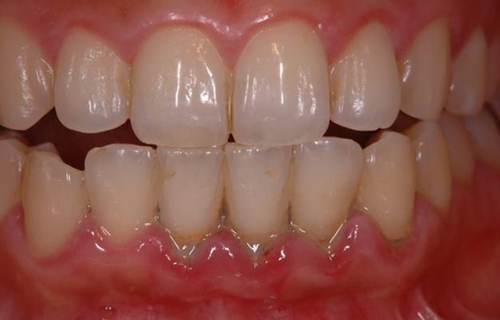 歯周治療2 Before